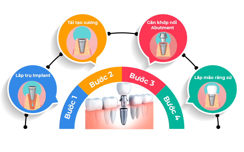 Nha khoa anh thu quy trinh Implant 